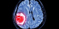 По каким симптомам рака мозга можно заподозрить опухоль?