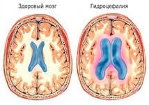Гидроцефалия головного мозга на МРТ у взрослых: насколько это опасно?